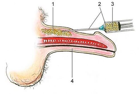 Introducing subcutaneous fat tissue of the penis