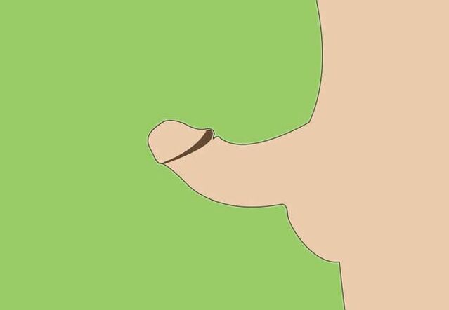 Curvature of the penis is an indication for surgical enlargement